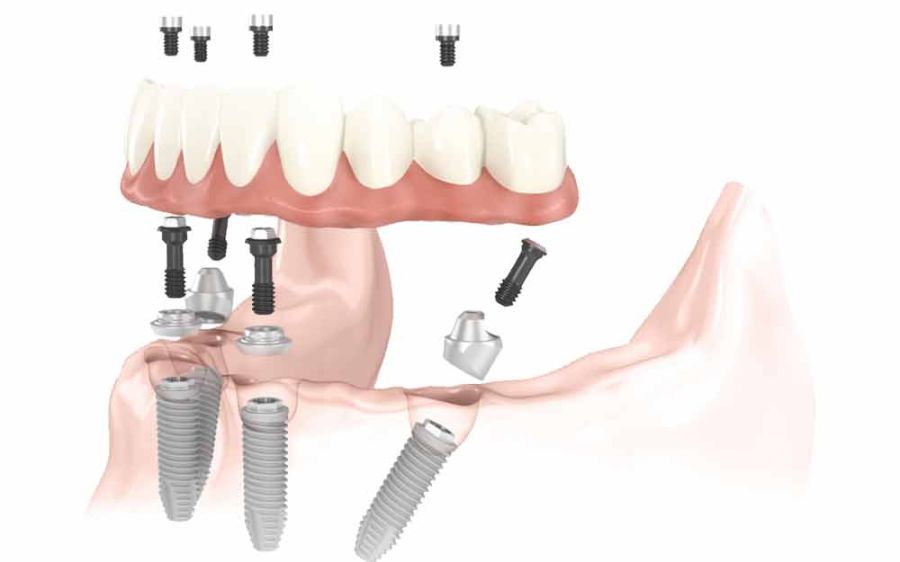 turismo dentale Archivi - Viaggi del Dente - Viaggi e Cure Dentistiche dai  Migliori Dentisti in Croazia e in Albania